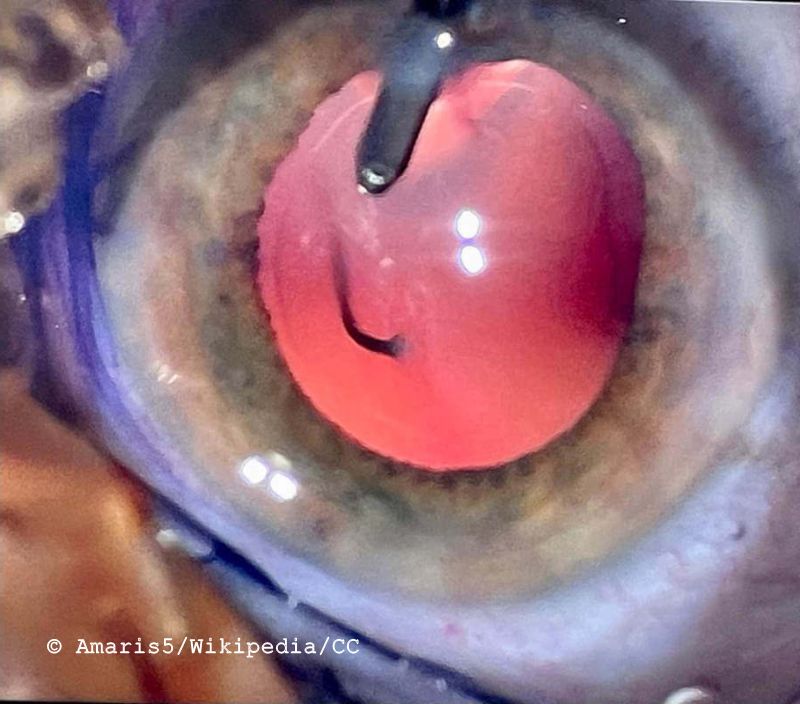 Arteria-hyaloidea-persistens 